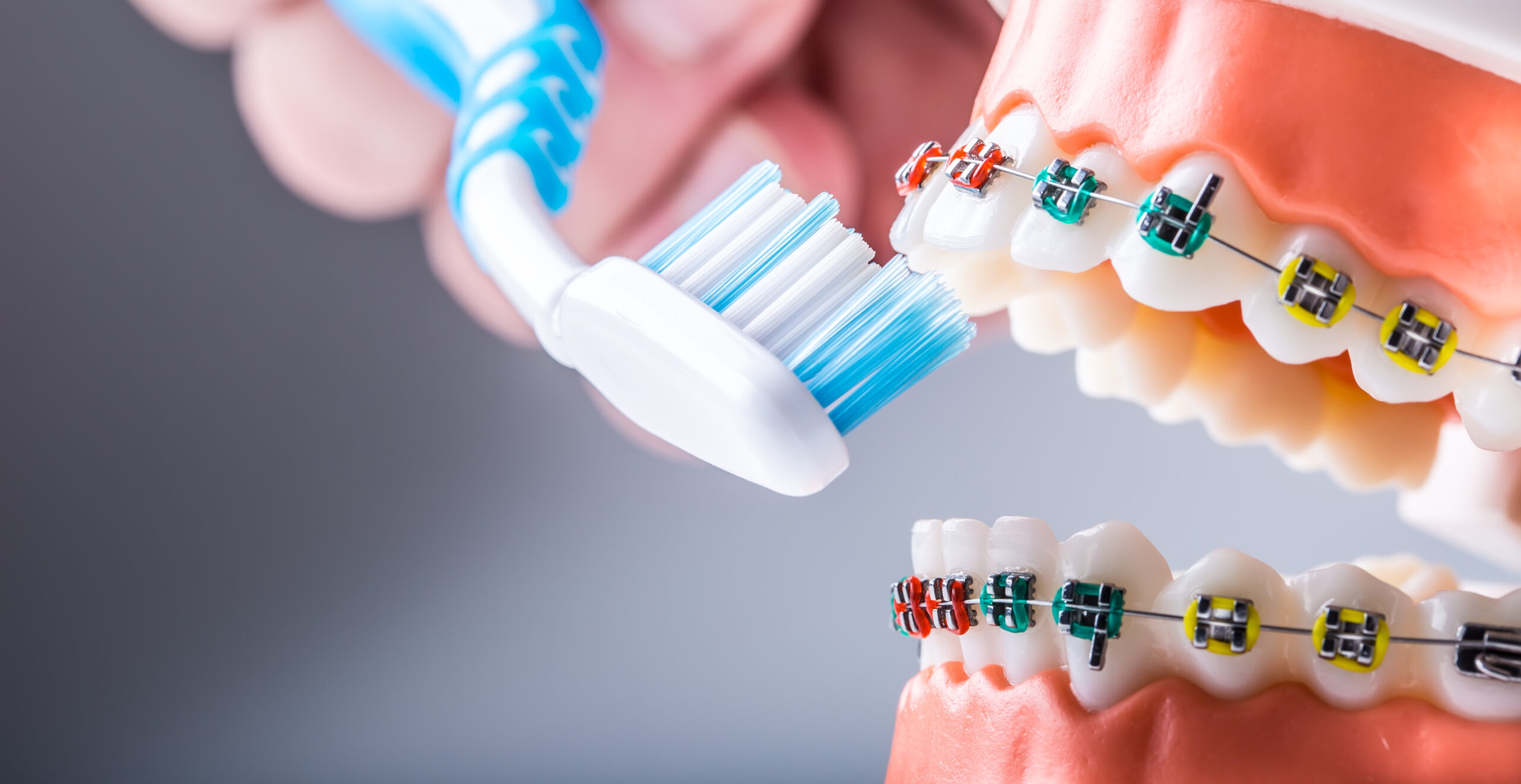 名古屋　歯医者　ほほえみ歯科名古屋院　矯正時の歯磨き方法