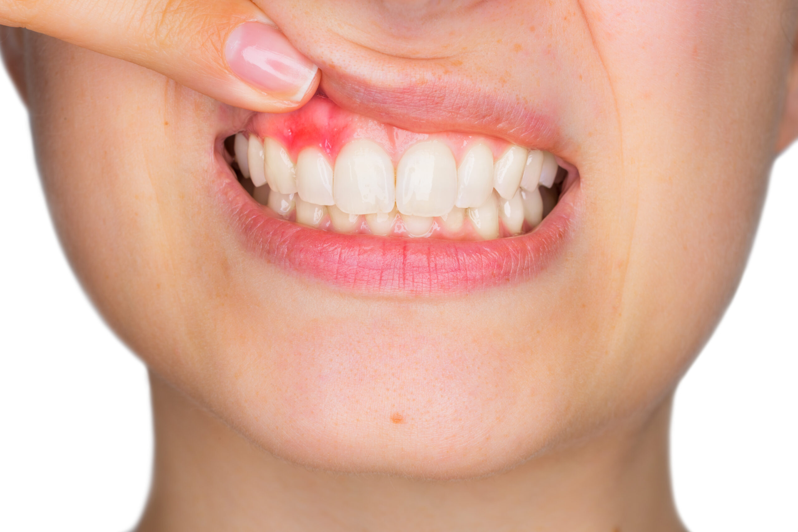 名古屋　歯医者　ほほえみ歯科名古屋院　歯ぐきの腫れや痛み