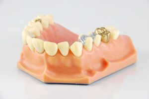 名古屋　歯医者　ほほえみ歯科名古屋院　歯の詰め物、被せ物