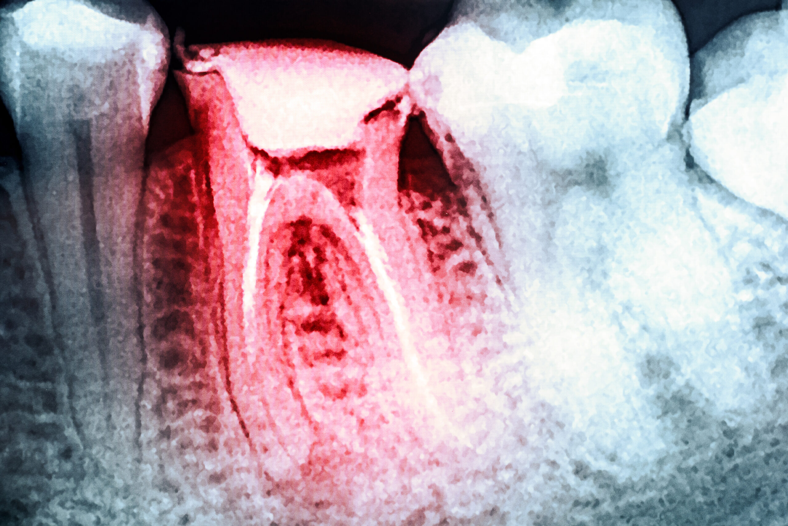 名古屋　歯医者　ほほえみ歯科名古屋院　歯の根っこ　残根